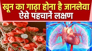 Blood के गाढ़ा होने से Health को होते है गंभीर नुकसान जानिए लक्षण और ब्लड पतला करने के उपाय [upl. by Ahsenot340]