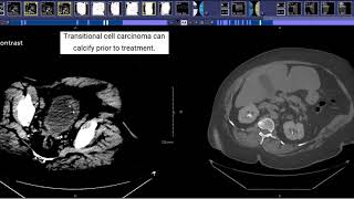 CT Urogram [upl. by Ennaylil]