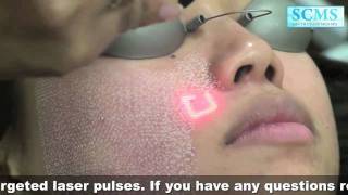 Laser Acne Scars [upl. by Talmud]