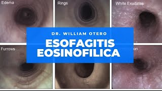 Esofagitis Eosinófilica Cómo diagnósticarlo y tratarlo en el 2021 [upl. by Karissa307]