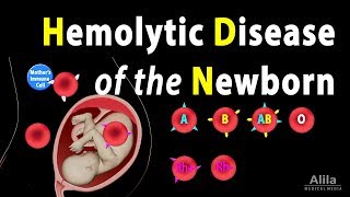 Hemolytic Disease of the Newborn HDN Animation [upl. by Furtek]