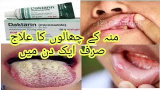 daktarin oral gel how to use miconazole gel oral thrush treatment [upl. by Wershba]