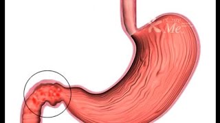 DUODENITIS INFLAMACIÓN DEL DUODENO [upl. by Rider296]