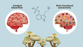 Psilocybin may ‘reset’ the brain to help manage treatmentresistant depression [upl. by Ecirad]