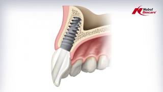 Angulated Screw Channel ASC Abutment [upl. by Anovad]