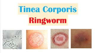 Ringworm Tinea Corporis  Causes Risk Factors Signs amp Symptoms Diagnosis and Treatment [upl. by Gonyea54]