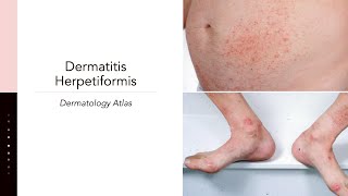 Dermatitis Herpetiformis [upl. by Nitsuj]