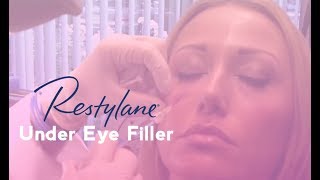 Restylane Under Eye Filler  Total Dermatology [upl. by Newhall549]