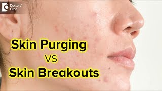 What is skin purging  Is it the same as skin breakouts  Dr Rajdeep MysoreDoctors Circle [upl. by Rekcut]