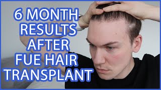 How a hair transplant can change your life  BBC [upl. by Notlek]