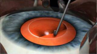 Phacoemulsification Cataract Surgery [upl. by Lesli]