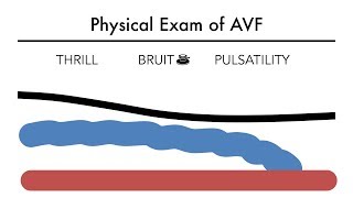 Hemodialysis Access 101 03  Physical Exam of AVF [upl. by Nert]