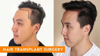 Hair Transplant Forehead Reduction Procedure for Traction Alopecia  Dr Matt Huebner Mela [upl. by Sivle]