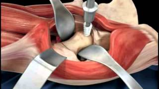 Parts of the broad ligament [upl. by Ylle999]