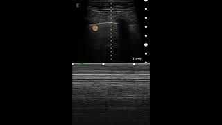 Pneumothorax Ultrasound Image Interpretation [upl. by Arehs]