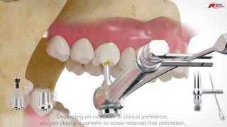 On1 concept intraoral scanning  Nobel Biocare [upl. by Neerroc]