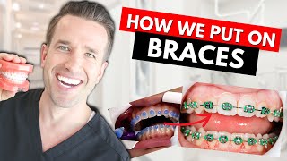 How Braces are Put On  Part IV Dr Nate [upl. by Enneiviv]