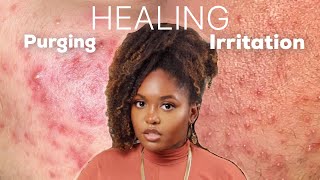 PURGING OR IRRITATION  Esthetician Explains How to Identify and Treat Both Conditions [upl. by Inal]