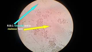 Stool analysisLab diagnosis of dysentery bacillary dysentery [upl. by Nolad]