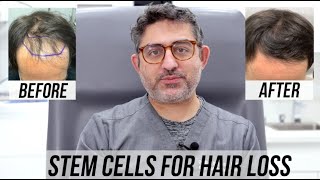 STEM CELL Hair Restoration 4 month Update [upl. by Mllly]