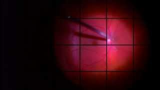 Retinal Detachment Repair 25 gauge Vitrectomy Gas Laser and Cryo [upl. by Kynan]