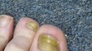 My Toenail Fungus Sucess Story [upl. by Nealah]