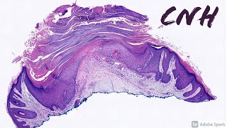 CNH Chondrodermatitis Nodularis Helicis Dermatology Mimic of Squamous Cell Carcinoma of Ear [upl. by Haldes159]