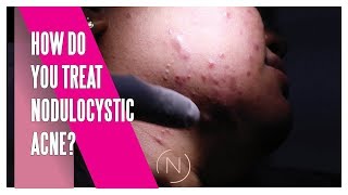 How Do You Treat Nodulocystic Acne  Houston Dermatology [upl. by Nnayr]