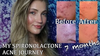 SPIRONOLACTONE FOR HORMONAL ACNE BEFORE  AFTER PICTURES MY EXPERIENCE AND WHY I STOPPED TAKING IT [upl. by Yennek]