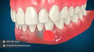 Gum Grafting Surgery  Dental Animation [upl. by Hareehat]