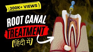 Root canal treatment in Hindi [upl. by Marta856]