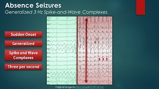 Absence Seizures EEG Findings [upl. by Aley85]