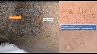 Ringworm and its causative agent dermatophyte under microscope [upl. by Atiseret]