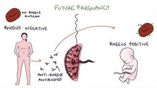 Understanding Rhesus Status and AntiD in Pregnancy [upl. by Anyrak]