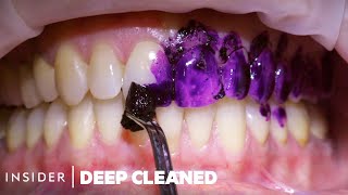 How Teeth Are Professionally Deep Cleaned  Deep Cleaned [upl. by Brande]