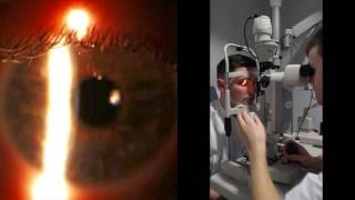 Slit Lamp Optical Section and Parallelpiped [upl. by Zane]