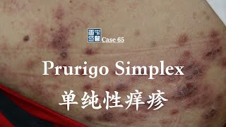 Prurigo Simplex treated by natural and safe way [upl. by Avra]