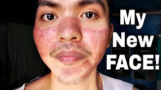 My Fractional CO2 Laser Treatment Experience TAGALOG [upl. by Idaf229]