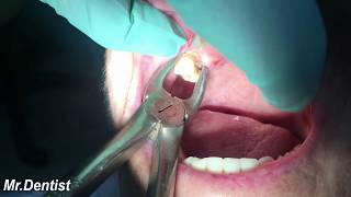 Extraction Of Molar Tooth [upl. by Pavkovic]