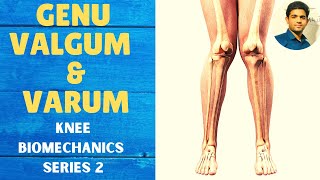 GENU VALGUM amp GENU VARUM  Knee Complex Biomechanics [upl. by Miun]