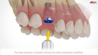 On1 restorative concept  Nobel Biocare [upl. by Awahsoj66]